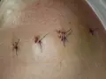 Skóra z kilkoma ranami pooperacyjnymi, zaszytymi niebieską nicią. Widoczny węzeł chirurgiczny.