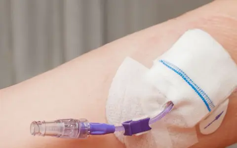 Cewnik do żywienia pozajelitowego podłączony do ręki. Zapewnia niezbędne składniki odżywcze, gdy tradycyjne żywienie jest niemożliwe.