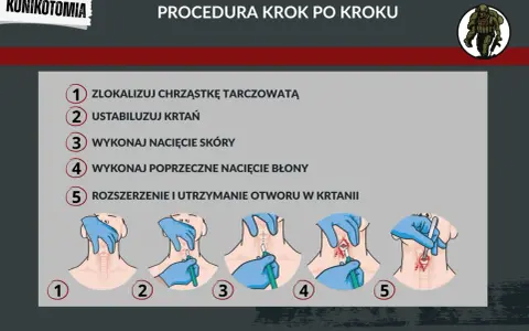 Ilustracja przedstawia procedurę konikotomii ratunkowej krok po kroku: lokalizacja chrząstki, stabilizacja krtani, nacięcie skóry i błony, rozszerzenie otworu.