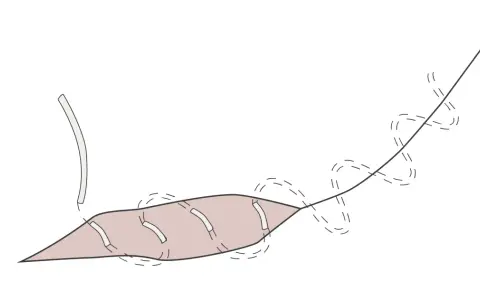 Ilustracja przedstawia szew śródskórny, gdzie nici chirurgiczne są ukryte pod skórą, zapewniając estetyczne gojenie rany.