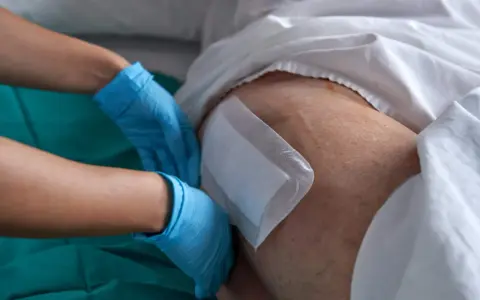Rękawiczki chirurgiczne zakładane na udo pacjenta, przygotowanie do zastosowania nowoczesnych metod leczenia ran przewlekłych.