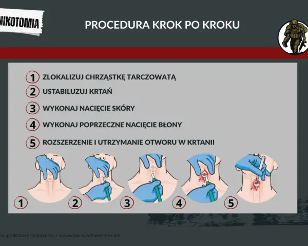 Ilustracja przedstawia procedurę konikotomii ratunkowej krok po kroku: lokalizacja chrząstki, stabilizacja krtani, nacięcie skóry i błony, rozszerzenie otworu.