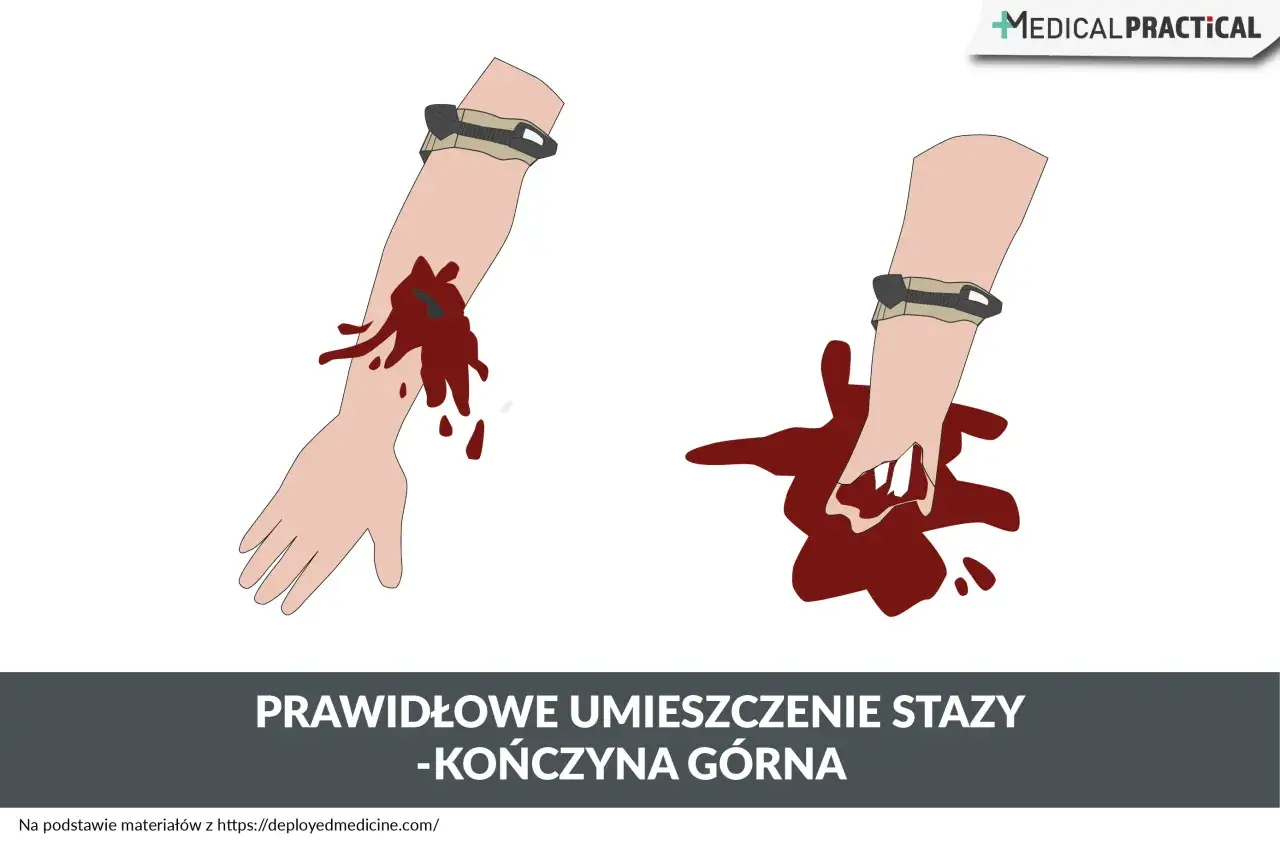 Dwie ręce z ranami i krwią. Na jednej ręce widać zakładanie stazy. Poniżej napis: PRAWIDŁOWE UMIESZCZENIE STAZY - KOŃCZYNA GÓRNA.